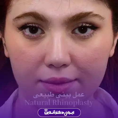 نمونه جراحی قبل و بعد بینی مدل طبیعی دکتر جاودانی در تهران 3