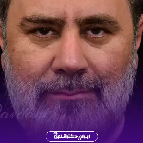 نمونه جراحی قبل و بعد بینی مدل طبیعی دکتر جاودانی در تهران 4
