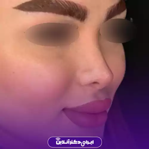 انواع عمل بینی 41 مدل بینی کلیپسی یا منگنهای