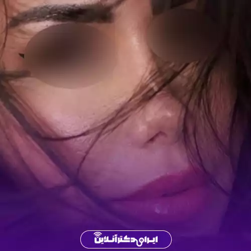 انواع عمل بینی 44 مدل بینی عروسکی