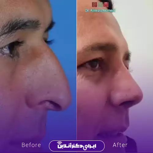 قبل و بعد جراحی بینی استخوانی در اصفهان؛ اصلاح قوز و کاهش برجستگی بینی، نمونه کار دکتر علیرضا مومنی