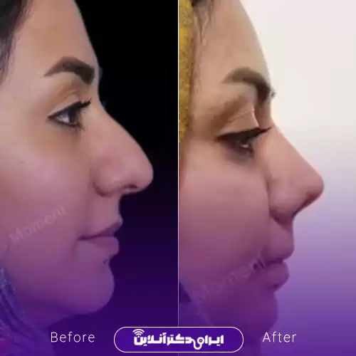 نمونه کار جراحی بینی استخوانی در اصفهان؛ نیم‌رخ قبل و بعد از عمل توسط دکتر علیرضا مومنی