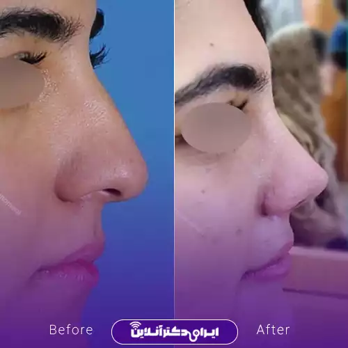 قبل و بعد جراحی بینی استخوانی در اصفهان؛ کاهش برجستگی پشت بینی و تغییر نیم‌رخ، دکتر علیرضا مومنی