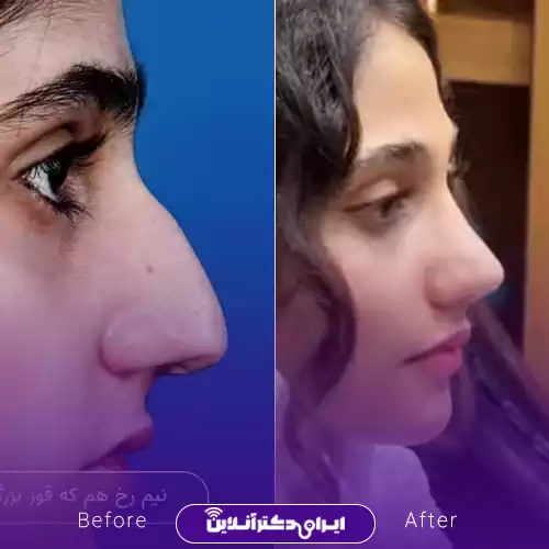 نمونه قبل و بعد عمل بینی در اصفهان؛ نوک بینی ظریف‌تر و نیم‌رخ هماهنگ‌تر، دکتر علیرضا پورصیرفی