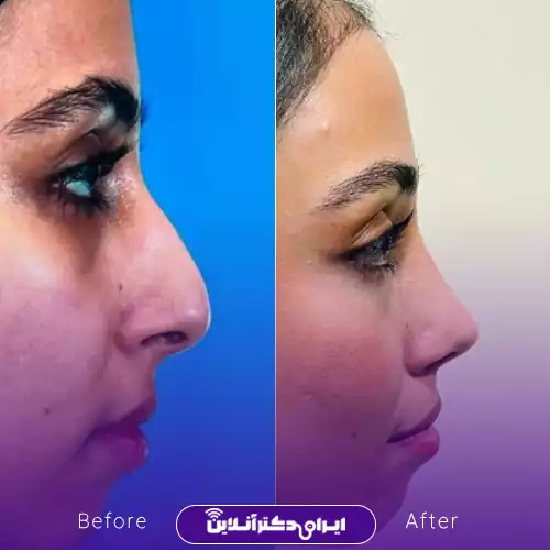 قبل و بعد عمل بینی استخوانی در اصفهان؛ اصلاح قوز بینی و نیم‌رخ هماهنگ‌تر، نمونه کار دکتر علیرضا پورصیرفی