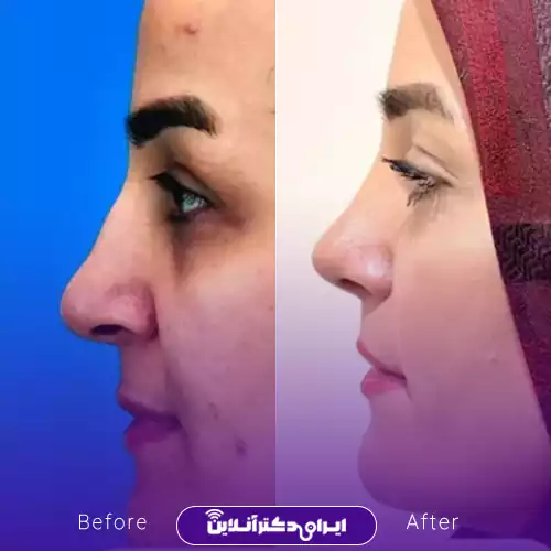 قبل و بعد عمل بینی استخوانی در اصفهان؛ اصلاح قوز بزرگ و صاف‌تر شدن خط نیم‌رخ، نمونه کار دکتر علیرضا پورصیرفی