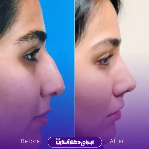 قبل و بعد عمل بینی استخوانی در اصفهان، دکتر علیرضا پورصیرفی