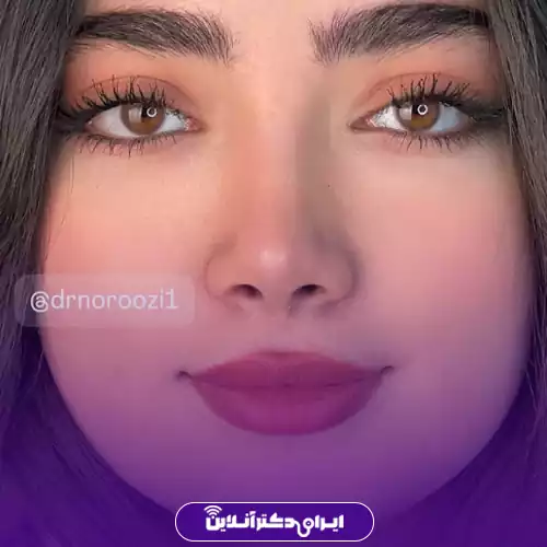 نمونه کار عمل بینی گوشتی خانم توسط دکتر امین نوروزی، متخصص جراحی دهان، فک و صورت