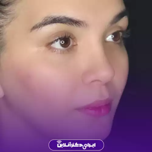نمونه کار قبل و بعد عمل بینی سبک طبیعی در تهران توسط دکتر انصاری 1