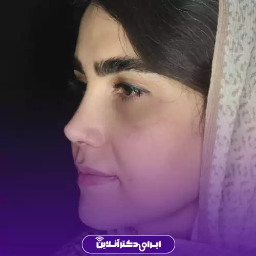 نمونه کار قبل و بعد عمل بینی سبک طبیعی در تهران توسط دکتر انصاری 2