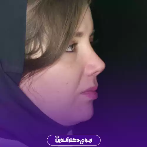 نمونه کار قبل و بعد عمل بینی سبک طبیعی در تهران توسط دکتر انصاری 3