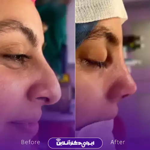 نیم‌رخ قبل و بعد از جراحی بینی استخوانی در اصفهان؛ نمونه کار دکتر آزاده کازرونی