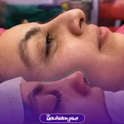 مقایسه خط نیم‌رخ بینی قبل و بعد از جراحی بینی استخوانی در اصفهان با خطوط راهنما، دکتر آزاده کازرونی