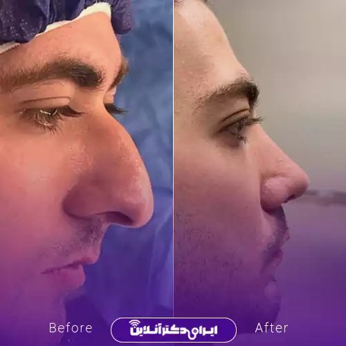 قبل و بعد جراحی بینی استخوانی در اصفهان؛ اصلاح قوز و کاهش برجستگی بینی، نمونه کار دکتر آزاده کازرونی