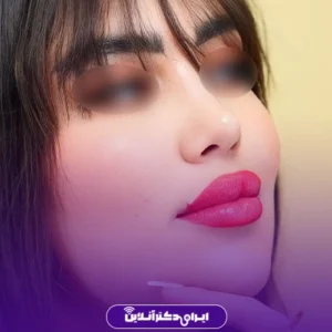 نمونه کار عمل بینی دکتر هادی سرمست 2