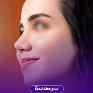 نمونه کار عمل بینی دکتر هادی سرمست 4