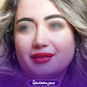 نمونه کار عمل بینی دکتر هادی سرمست 6