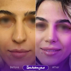 نمونه کار عمل بینی دکتر هادی سرمست 8