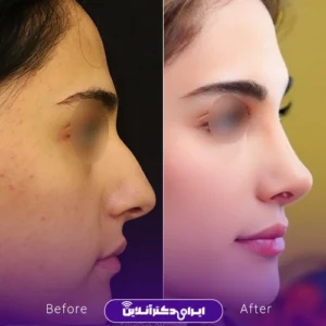 نمونه کار عمل بینی دکتر هادی سرمست 9