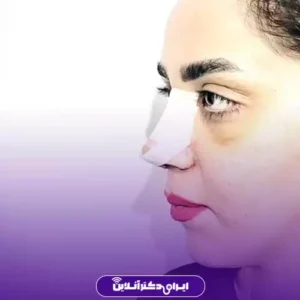 نمونه کار عمل بینی دکتر حمید نوری 5