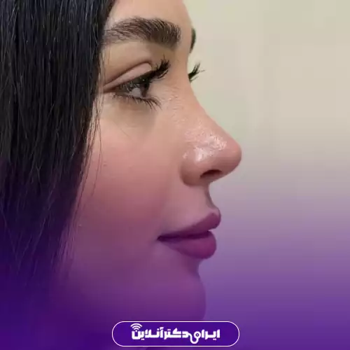 نمونه کار جراحی بینی گوشتی خانم‌ها دکتر حمیدرضا مفرد در شهر کرج