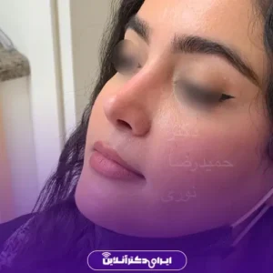 نمونه کار عمل بینی دکتر حمیدرضا نوری 10