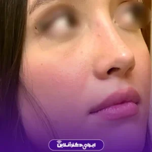 نمونه کار عمل بینی دکتر حمیدرضا نوری 3