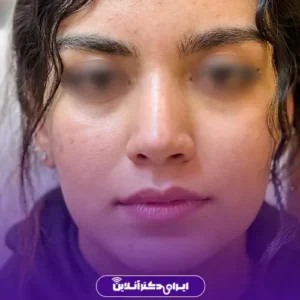 نمونه کار عمل بینی دکتر حمیدرضا نوری 6