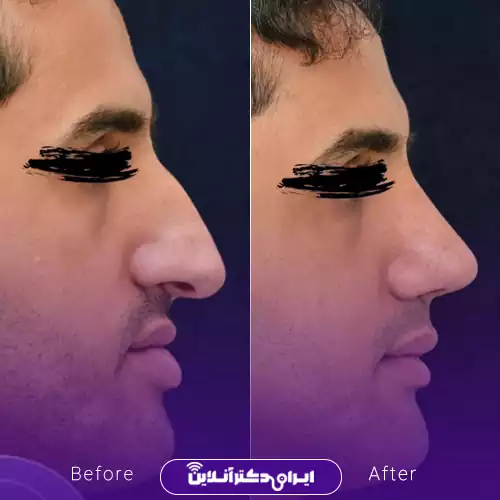 قبل و بعد عمل بینی استخوانی در اصفهان؛ کاهش قوز و برجستگی پشت بینی در نیم‌رخ، نمونه کار دکتر ایمان محمدی
