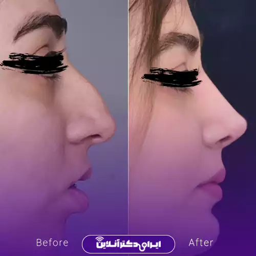 قبل و بعد عمل بینی استخوانی در اصفهان؛ اصلاح قوز و ظریف‌تر شدن نوک بینی، نمونه کار دکتر ایمان محمدی