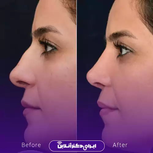 قبل و بعد عمل بینی استخوانی در اصفهان؛ حذف برجستگی پشت بینی و نیم‌رخ هماهنگ‌تر، نمونه کار دکتر ایمان محمدی