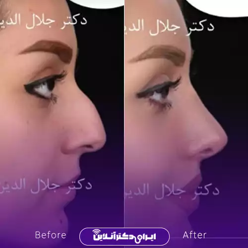 نمونه کار جراحی بینی استخوانی در اصفهان؛ نیم‌رخ قبل و بعد از عمل توسط دکتر جلال‌الدین شریعت