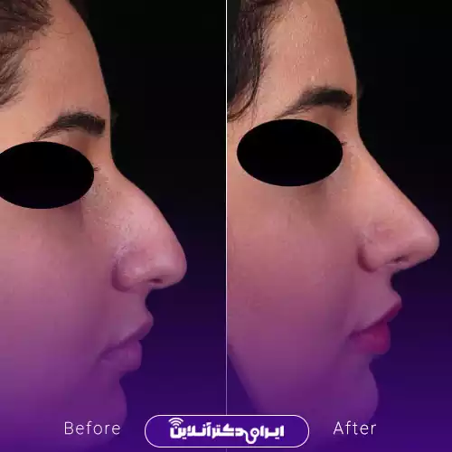 قبل و بعد جراحی بینی استخوانی در اصفهان؛ کاهش برجستگی پشت بینی، نمونه کار دکتر جلال‌الدین شریعت