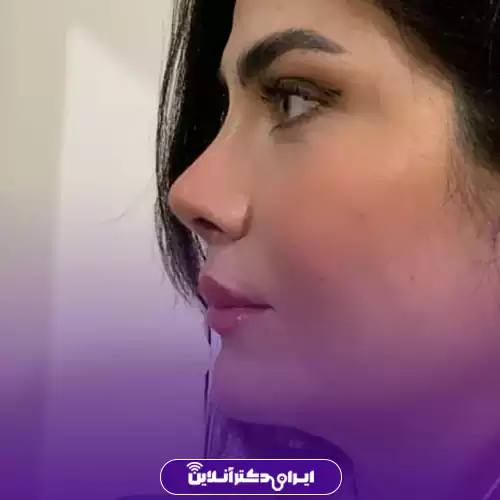 نمونه کار جراحی بینی گوشتی خانم توسط دکتر کاظم زرگری، فوق‌تخصص جراحی زیبایی