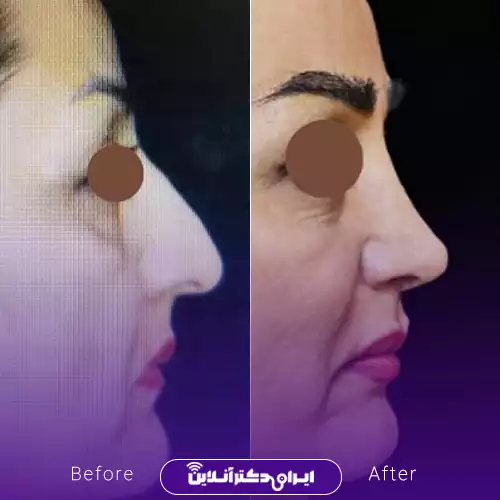 قبل و بعد عمل بینی استخوانی در اصفهان؛ اصلاح قوز و بالاتر رفتن نوک بینی در نیم‌رخ، نمونه کار دکتر محمود عمرانی‌فرد