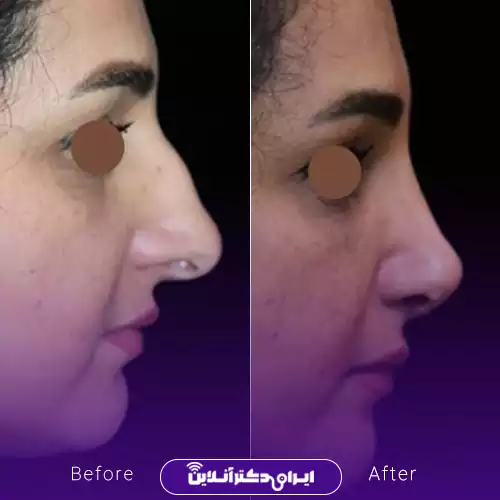قبل و بعد عمل بینی استخوانی در اصفهان؛ کاهش برجستگی پشت بینی و ظریف‌تر شدن نوک بینی، نمونه کار دکتر محمود عمرانی‌فرد