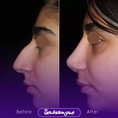 قبل و بعد عمل بینی استخوانی در اصفهان؛ حذف قوز بینی و اصلاح خط نیم‌رخ، نمونه کار دکتر محمود عمرانی‌فرد