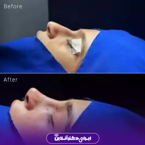 قبل و بعد عمل بینی استخوانی در اصفهان؛ اصلاح قوز و بالاتر رفتن نوک بینی در نیم‌رخ، نمونه کار دکتر مجید راستی