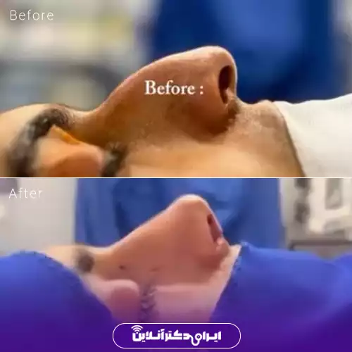 قبل و بعد عمل بینی استخوانی در اصفهان؛ کاهش قوز و اصلاح خط پشت بینی بلافاصله پس از عمل، نمونه کار دکتر مجید راستی