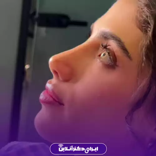 نمونه قبل و بعد جراحی بینی طبیعی تهران دکتر مجیدی 2