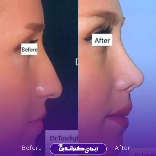 نمونه کار قبل و بعد جراحی بینی گوشتی نیم‌رخ خانم توسط دکتر منصور توفیقی زواره در کرج