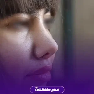 نمونه کار عمل بینی دکتر مسعود راستکاری 10