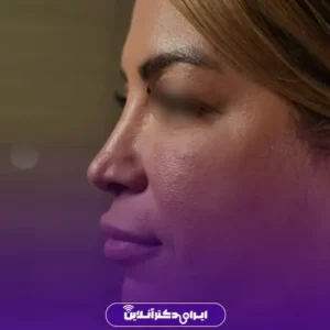 نمونه کار عمل بینی دکتر مسعود راستکاری 3