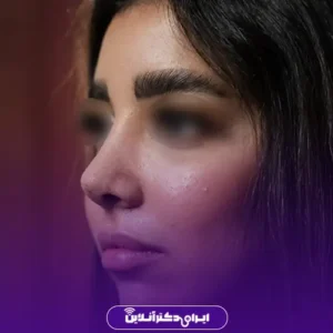 نمونه کار عمل بینی دکتر مسعود راستکاری 4