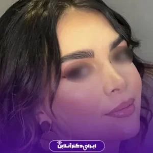 نمونه کار عمل بینی دکتر مسعود راستکاری 8