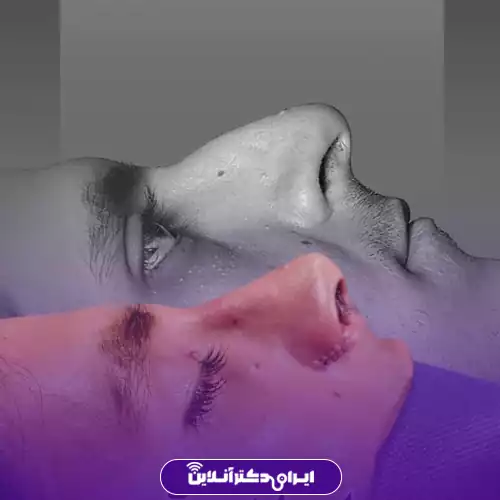 نمای نزدیک بینی بیمار بعد از جراحی بینی استخوانی در اصفهان کنار عکس مرجع، دکتر مهدی قدیری
