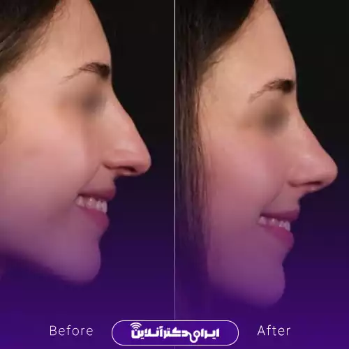 نمونه کار عمل بینی دکتر محمد مازنی کاشمر 4
