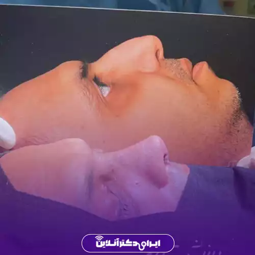 قبل و بعد عمل بینی استخوانی در اصفهان؛ عکس نیم‌رخ پیش از جراحی کنار صورت بیمار مرد پس از عمل، دکتر محمد مهدی طرزی