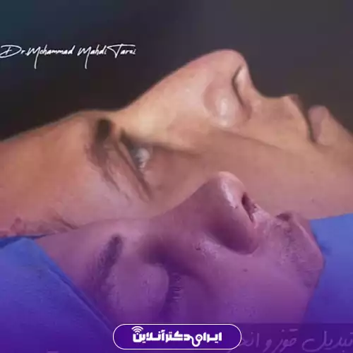 قبل و بعد عمل بینی استخوانی در اصفهان؛ اصلاح قوز و تغییر خط نیم‌رخ بینی در اتاق عمل، نمونه کار دکتر محمد مهدی طرزی