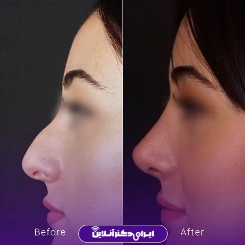 نمونه کار قبل و بعد جراحی بینی گوشتی خانم توسط دکتر محمدرضا سلیمی در کرج